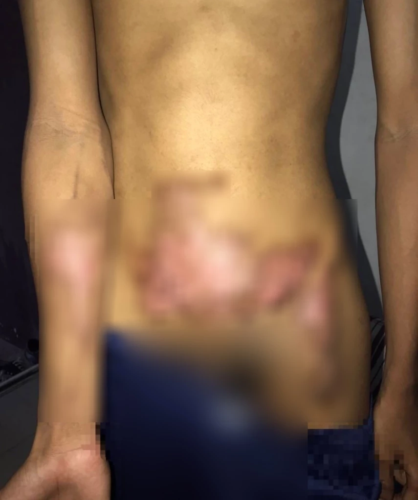 ร่องรอยบาดแผลที่ได้รับบาดเจ็บจากการ "รับน้องโหด" ของรุ่นพี่ปี 3