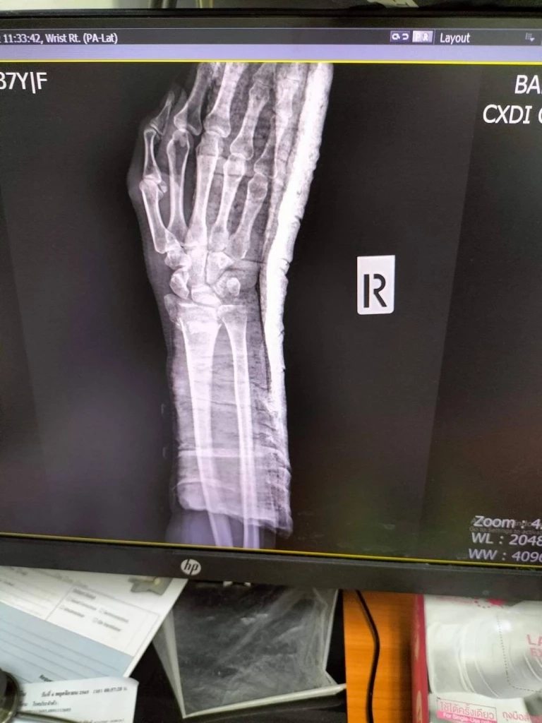 สาวร้อง! สจ.คนดัง จ.ปทุมธานี ทำร้ายแขนหัก ไม่รับผิดชอบ แถมขู่ดำเนินคดี