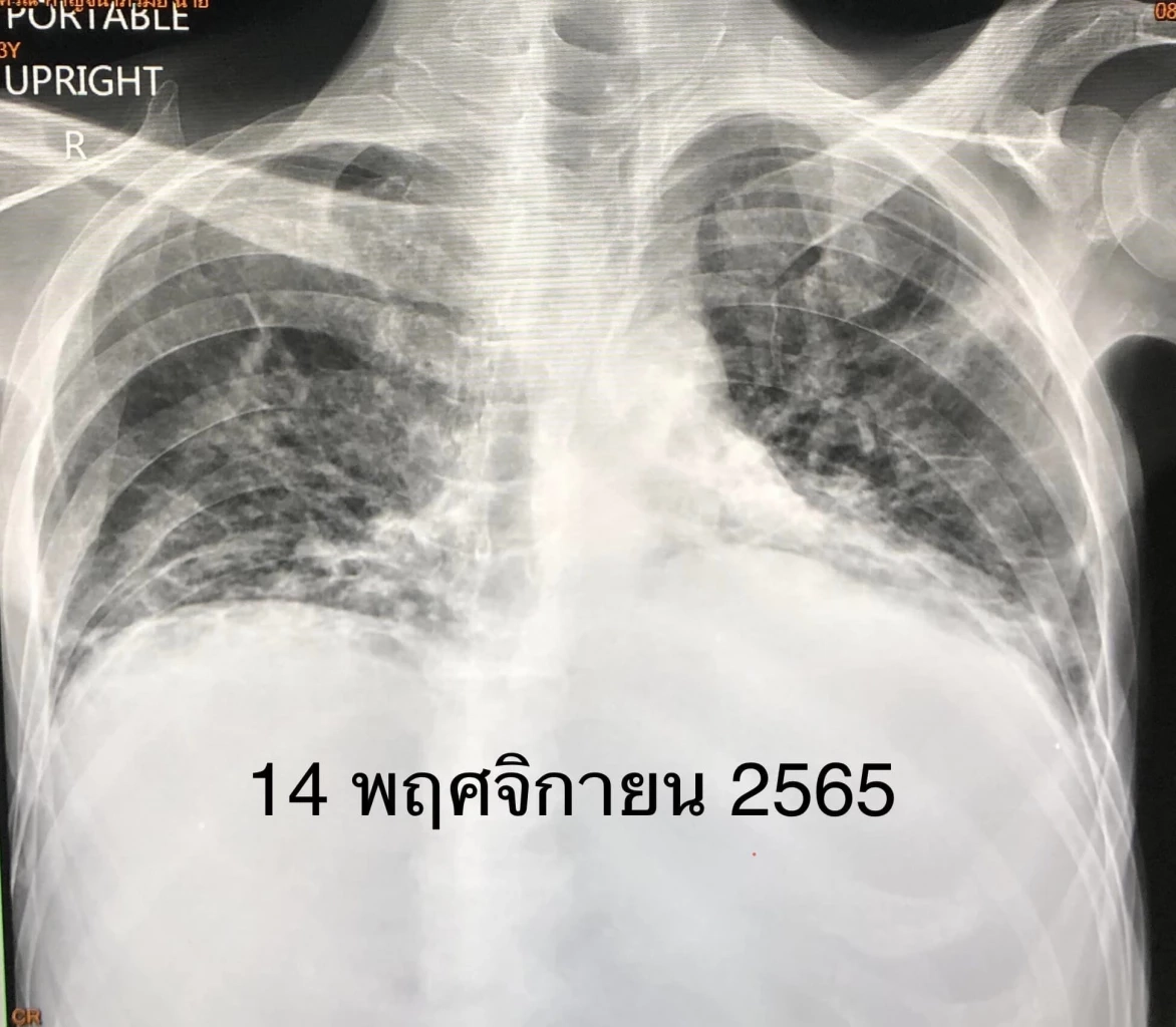 แพทย์ดังยกเคส วัคซีนโควิด ช่วยชีวิตคนเป็นมะเร็งเม็ดเลือดขาว กลุ่ม 608 รีบฉีดวัคซีนด่วน