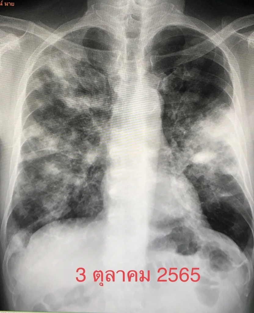 เคสสุดช็อก ผู้ป่วยไม่ได้ตรวจร่างกายกว่า 2 ปี พบเป็นโรคร้าย สุดท้ายเสียชีวิต!!