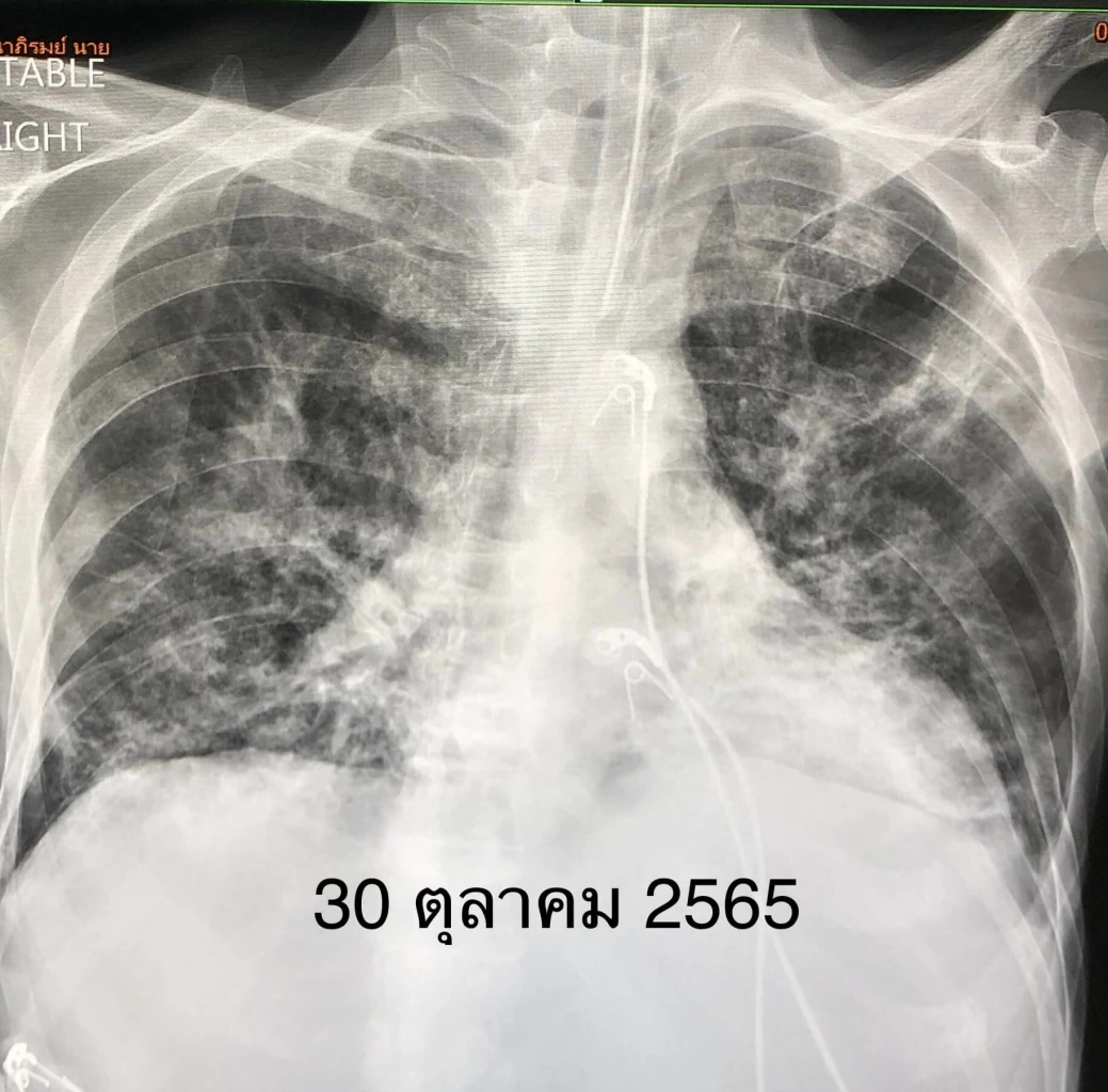 แพทย์ดังยกเคส วัคซีนโควิด ช่วยชีวิตคนเป็นมะเร็งเม็ดเลือดขาว กลุ่ม 608 รีบฉีดวัคซีนด่วน