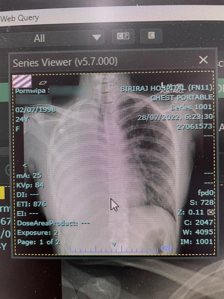 สุดช็อก! พยาบาล 24 ปี ป่วย“มะเร็งปอดระยะสุดท้าย” เชื่อสาเหตุบุหรี่มือสอง