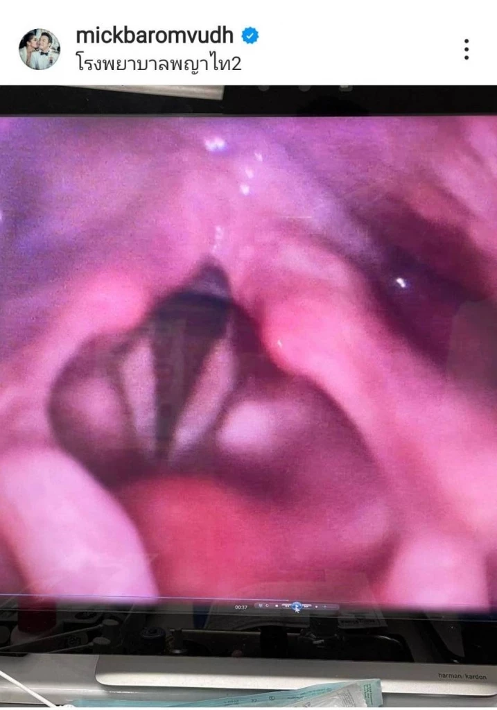 หลายคนห่วงใย “มิค บรมวุฒิ” โพสต์บอกข่าว ป่วยเส้นเสียงอักเสบ