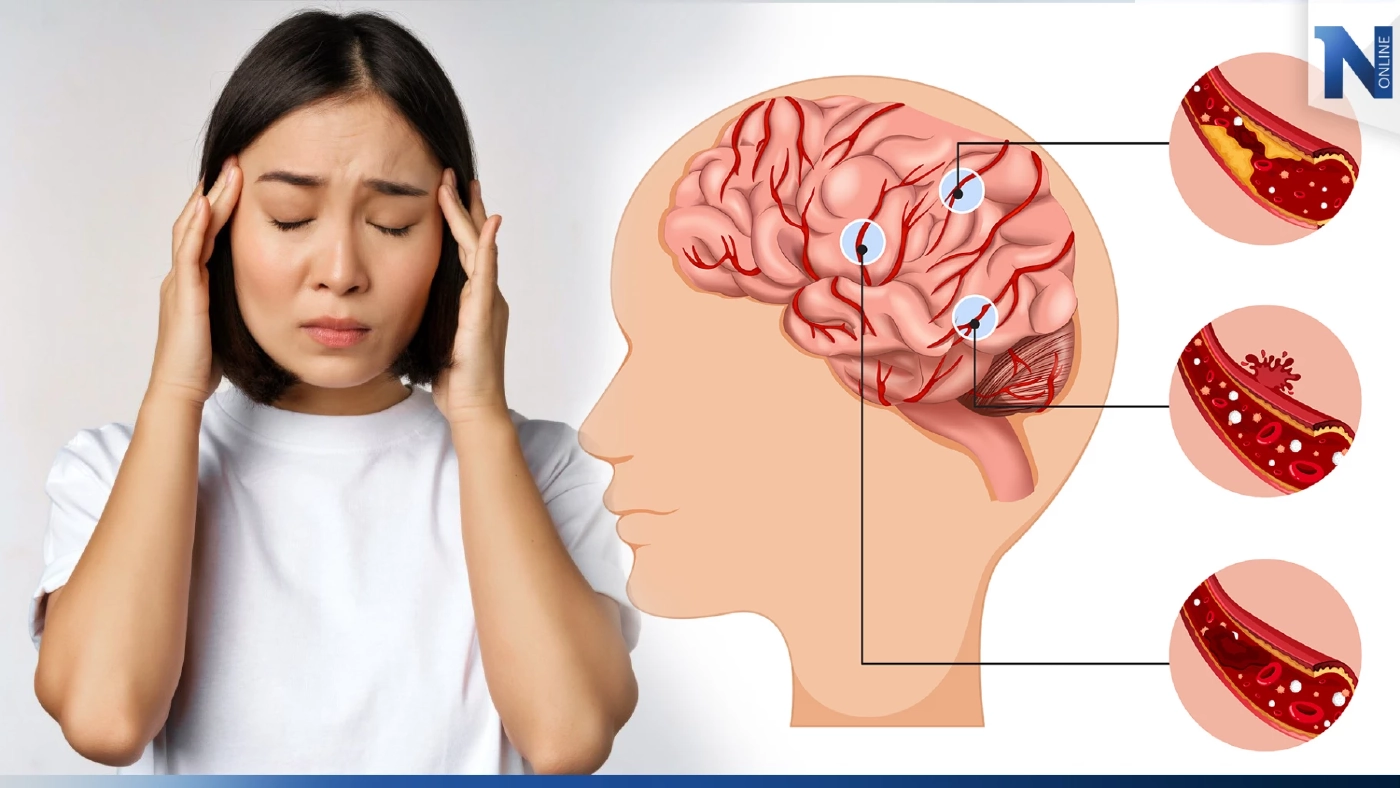 โรคหลอดเลือดสมอง (Stroke) รู้ทันป้องกันอัมพาต