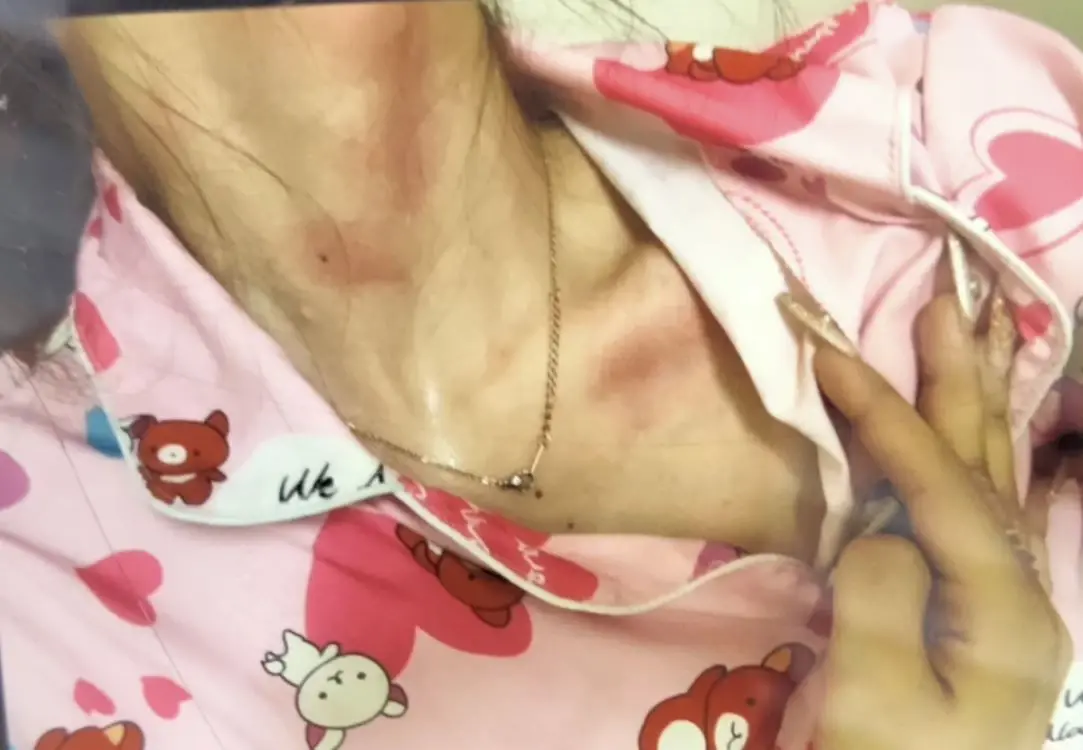 สาวผวา! ไอ้หื่นปีนห้องพักชั้น 4 หวังขืนใจ ต่อสู้สุดฤทธิ์-กัดปาก รอดหวุดหวิด