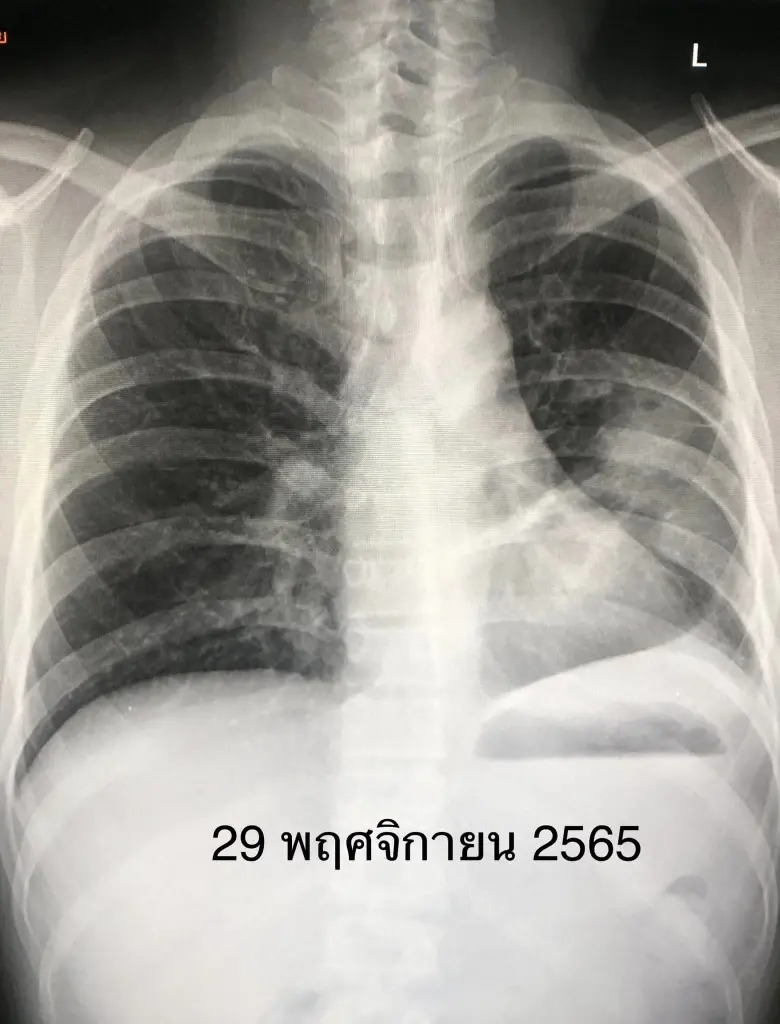 เตือน ระวังโควิดพันธุ์ XBB ระบาดที่อินเดีย คาดอีกไม่นานอาจแพร่ในไทย