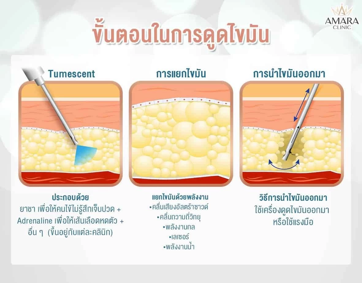 วิธีดูดไขมัน 