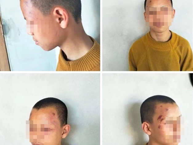 ร่องรอยการถูกทำร้ายของเณร