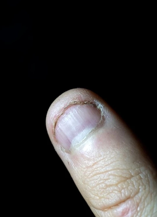 เช็กสัญญาณเตือนสุขภาพ ‘ความผิดปกติของเล็บ’ บ่งบอกอะไรได้บ้าง