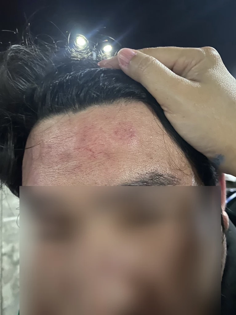 ร่องรอยบาดเจ็บที่ยังอยู่