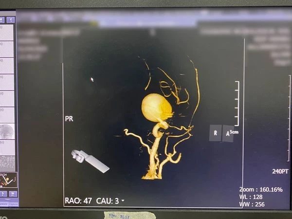 เคสใหญ่ ผู้ป่วยปวดหัว ตามัวมานาน ตัดสินใจพบแพทย์ ผลตรวจ MRI เผยความจริง