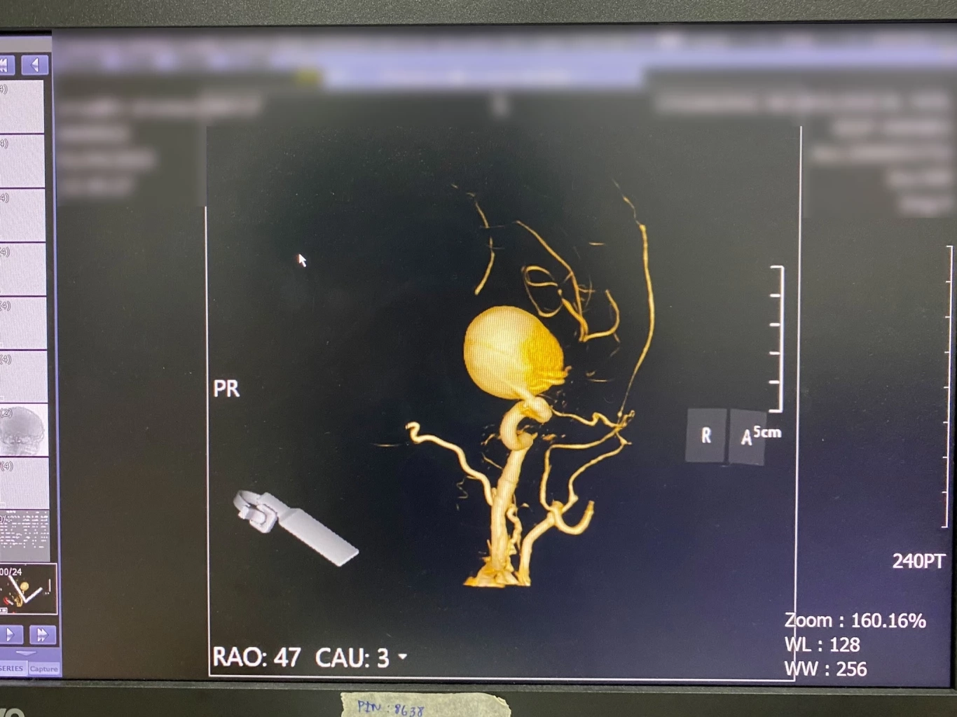 รู้จัก 'โรคเส้นเลือดสมองโป่งพอง' ภัยเงียบที่มากับอาการปวดศีรษะ