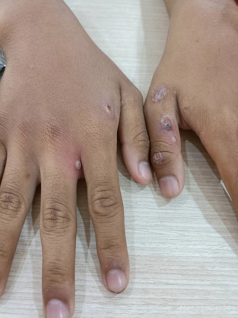 รุ่นพี่ ม.5 สุดโหด สั่งทำโทษ ม.1 ลงไปแช่บ่อเกรอะ ห้ามล้างตัว จนแผลติดเชื้อ