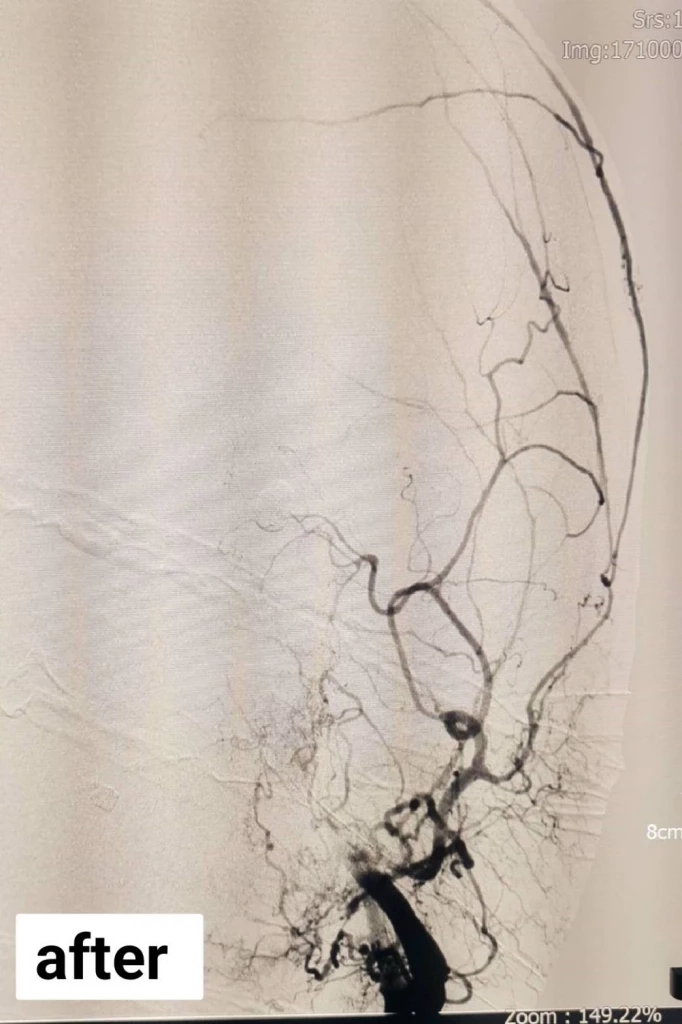 เคสใหญ่ ผู้ป่วยปวดหัว ตามัวมานาน ตัดสินใจพบแพทย์ ผลตรวจ MRI เผยความจริง