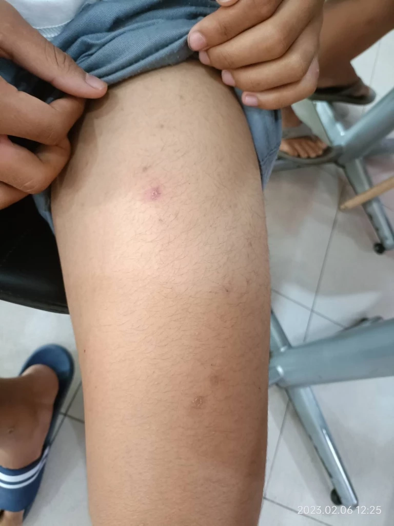 รุ่นพี่ ม.5 สุดโหด สั่งทำโทษ ม.1 ลงไปแช่บ่อเกรอะ ห้ามล้างตัว จนแผลติดเชื้อ