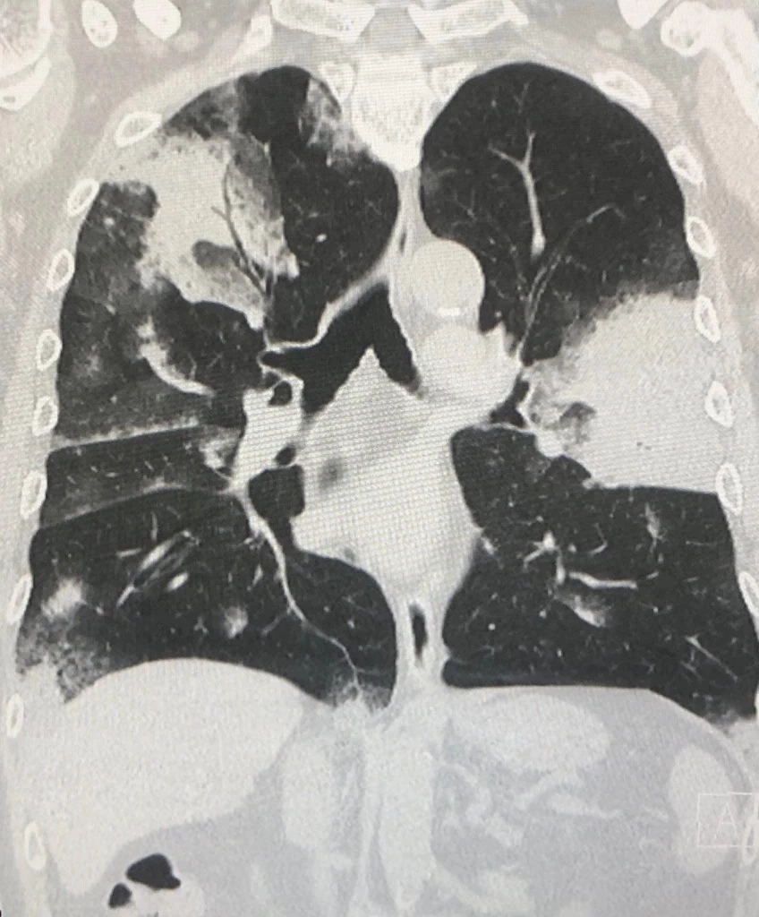 หมอมนูญ โพสต์  ไม่เข้าใจว่า ทำไมไทยไม่มียาต้านวัณโรคที่มียาหลายชนิดผสมในเม็ดเดียวกัน  