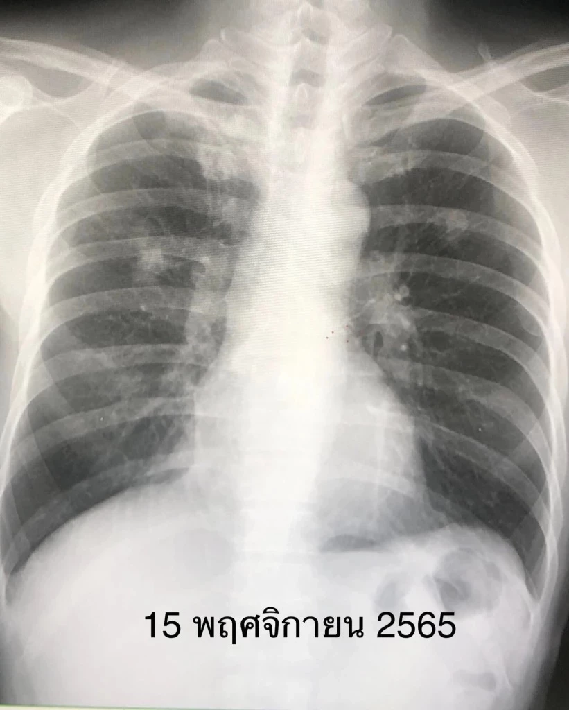 หมอมนูญ โพสต์  ไม่เข้าใจว่า ทำไมไทยไม่มียาต้านวัณโรคที่มียาหลายชนิดผสมในเม็ดเดียวกัน  