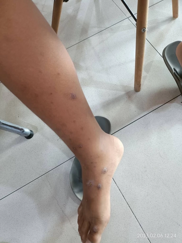 รุ่นพี่ ม.5 สุดโหด สั่งทำโทษ ม.1 ลงไปแช่บ่อเกรอะ ห้ามล้างตัว จนแผลติดเชื้อ