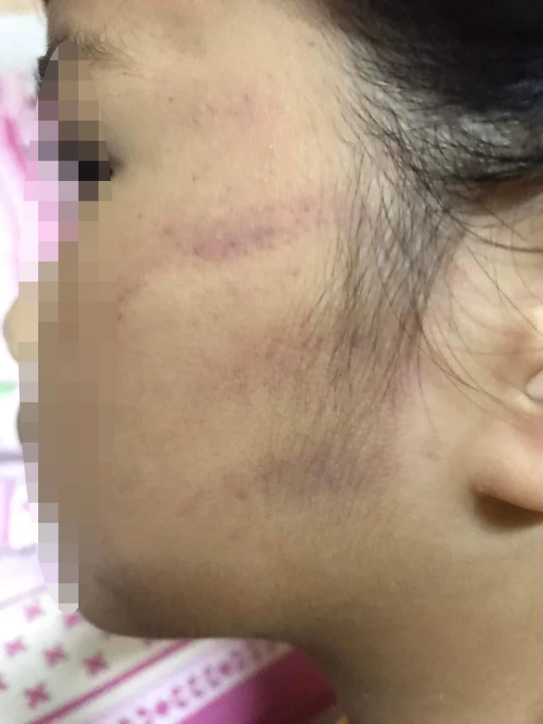 ร่องรอยที่เกิดขึ้นบนใบหน้าของเด็ก