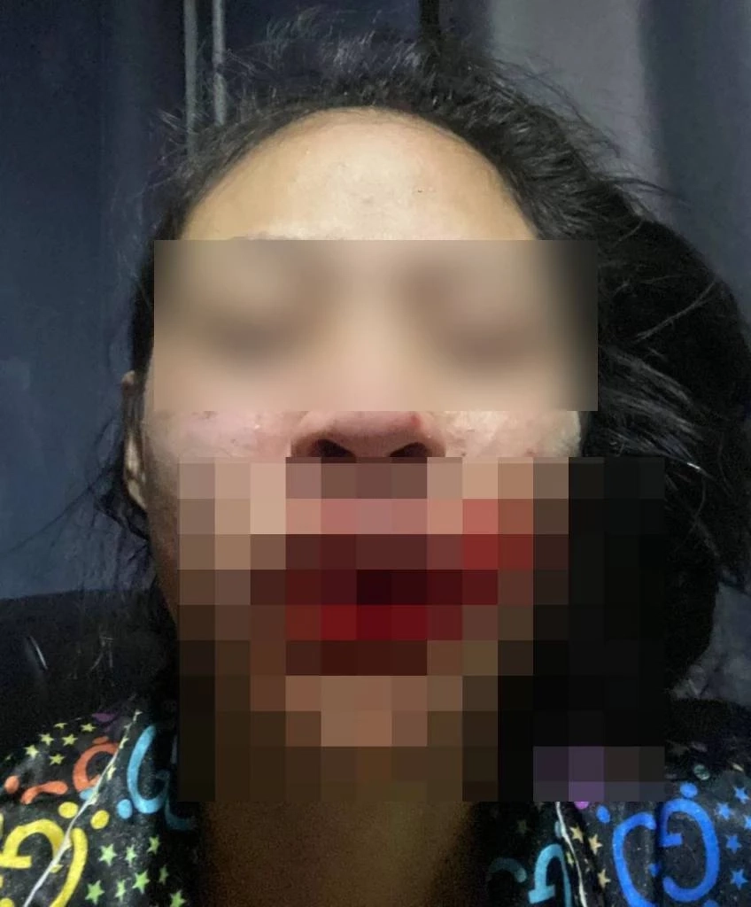 สาววัย 23 เข้าแจ้งความ ถูกรุ่นพี่ใช้น้ำอัดลมราดหน้า-รุมทำร้าย