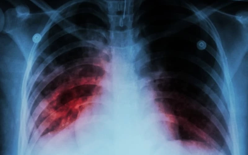 รู้จัก วัณโรคปอด อาการเป็นอย่างไร น่ากลัวขนาดไหน เพื่อพร้อมรับมือทุกสถานการณ์ 