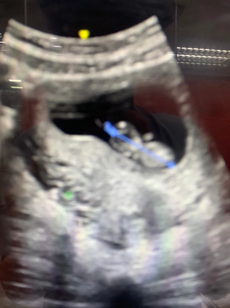 "กัน จอมพลัง"พาสาวท้อง 3 เดือน ถูกผัวทหารทำร้ายปางตาย บุกร้อง"กองทัพบก"