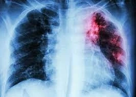 รู้จัก วัณโรคปอด อาการเป็นอย่างไร น่ากลัวขนาดไหน เพื่อพร้อมรับมือทุกสถานการณ์ 