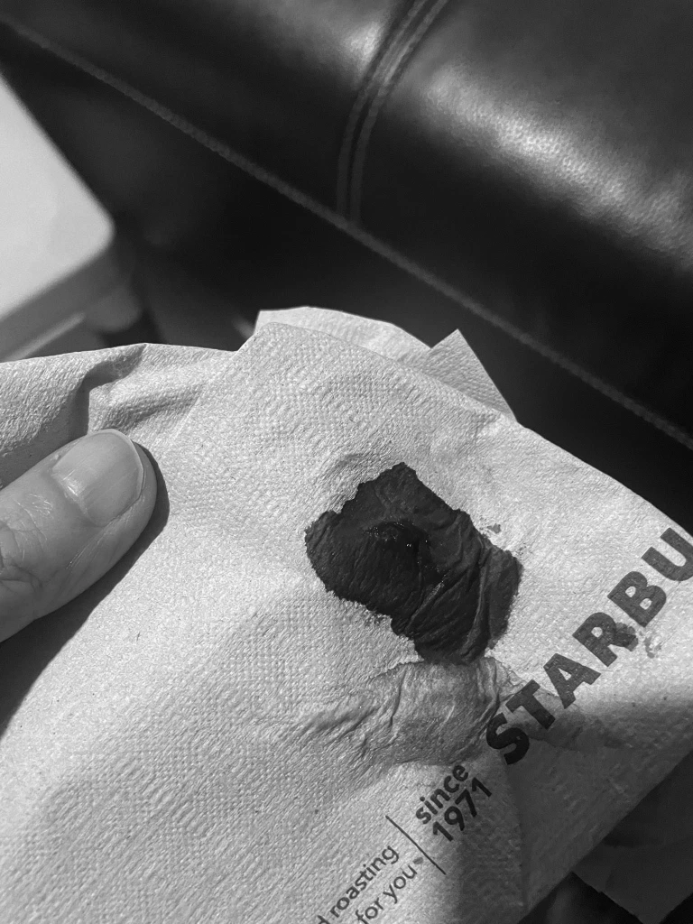 คุณแม่เชียงใหม่ แชร์"PM2.5"สุดอันตราย ลูกสาว 9 ขวบกำเดาไหลรุนแรง