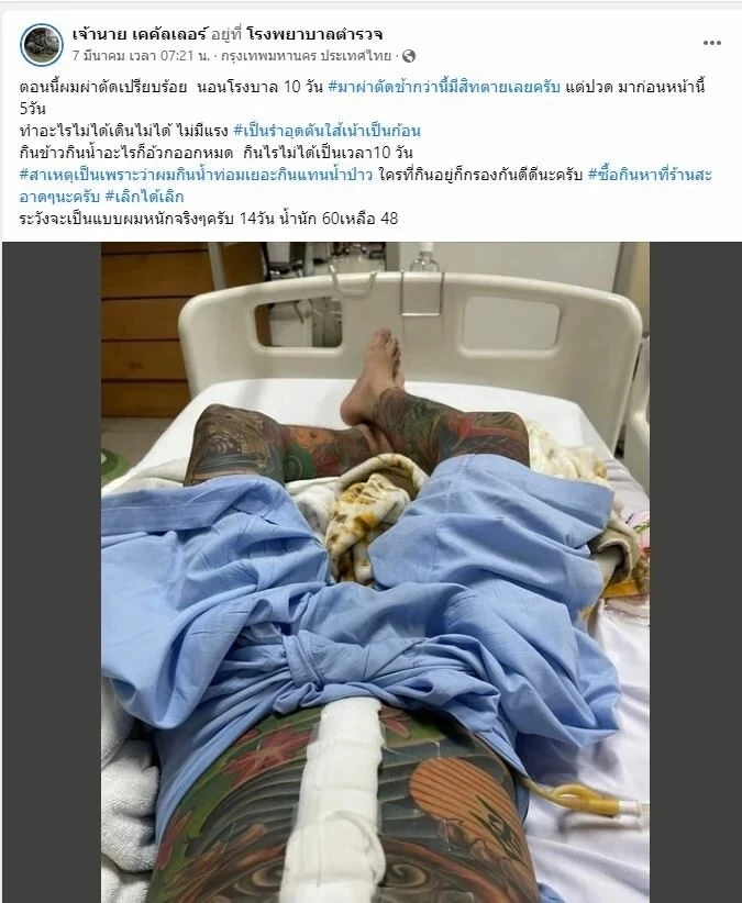 โซเชียลแห่แชร์ หนุ่มเฉียดดับ ปวดท้องหนัก 5 วัน เจอไส้เน่า รีบผ่าตัดช่วยชีวิต