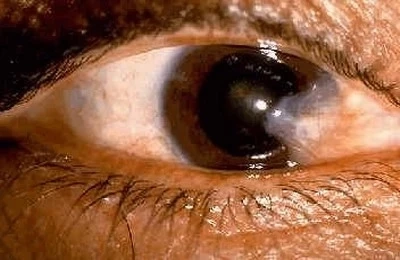 เตือนภัยเงียบ "ต้อหิน" อุปสรรคแห่งการมองเห็น สาเหตุจากอะไร อ่านที่นี่มีคำคอบ 