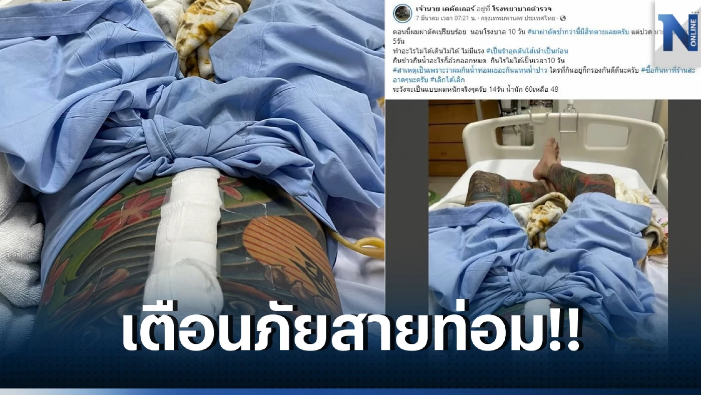 โซเชียลแห่แชร์ หนุ่มเฉียดดับ ปวดท้องหนัก 5 วัน เจอไส้เน่า รีบผ่าตัดช่วยชีวิต