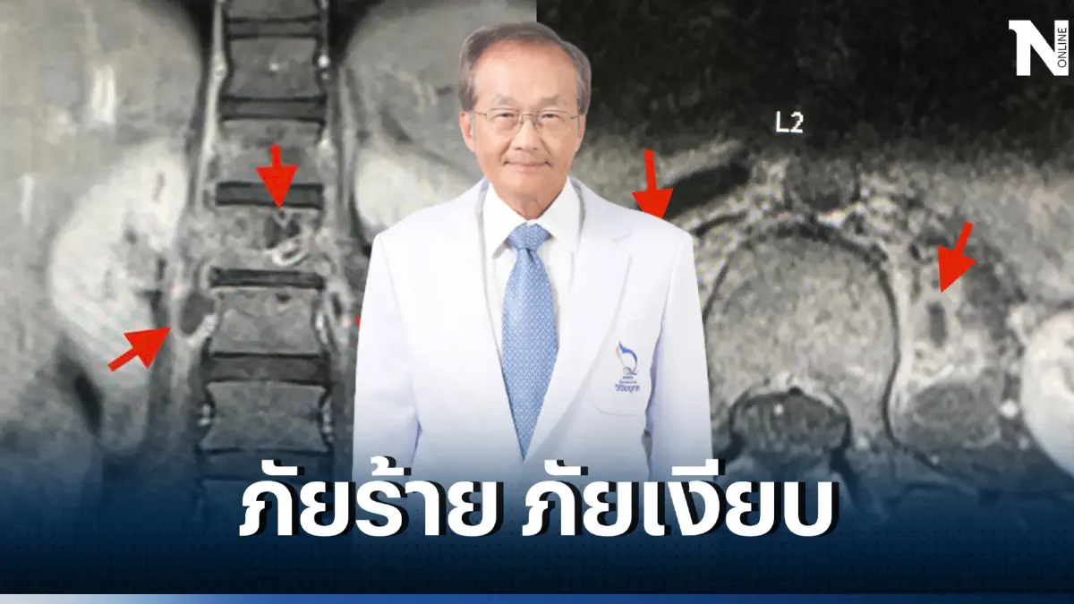 "แพทย์ดัง" เปิดเคส สาวปวดหลัง 7 เดือน ก้มตัวไม่ได้ เดินลำบาก ก่อนตรวจเจอต้นตอ...
