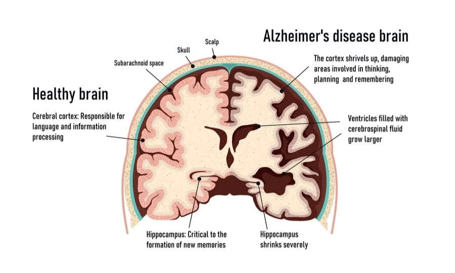 หมอดื้อเตือน "สมองเสื่อมวัยชราพุ่งสูง ตรวจรู้ล่วงหน้าช่วยได้ เอาชนะได้"