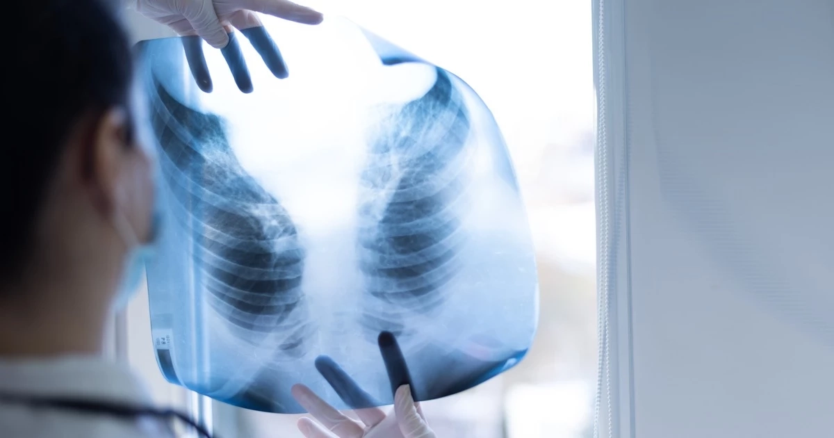 ข่าวดีคนรักปอด เปิดพิกัด 8 จุดวอล์คิน ตรวจปอดฟรี วันที่ 3- 21 เม.ย. ย้ำว่าฟรี