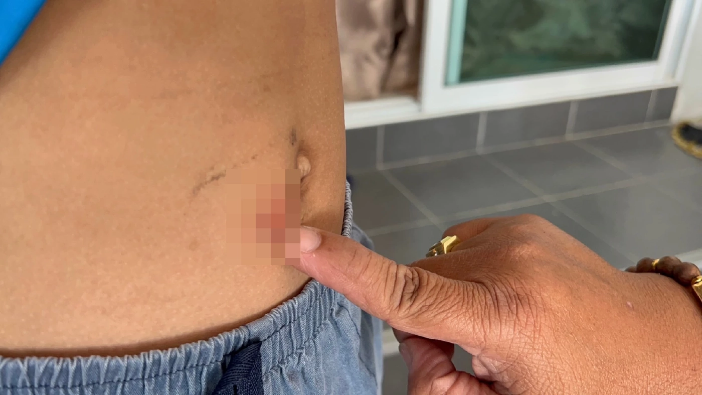 ตร.ล็อกตัวสอบสาวร้านชำ ใช้ถ่านร้อนจี้สะดือเด็กทำโทษ หลังเบี้ยวไม่ยอมมาพบ