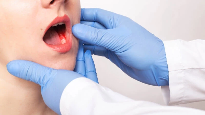 แพทย์เตือน มะเร็งช่องปาก เผยปัจจัยเสี่ยงที่จะเกิด มีอาการต้องรีบพบแพทย์