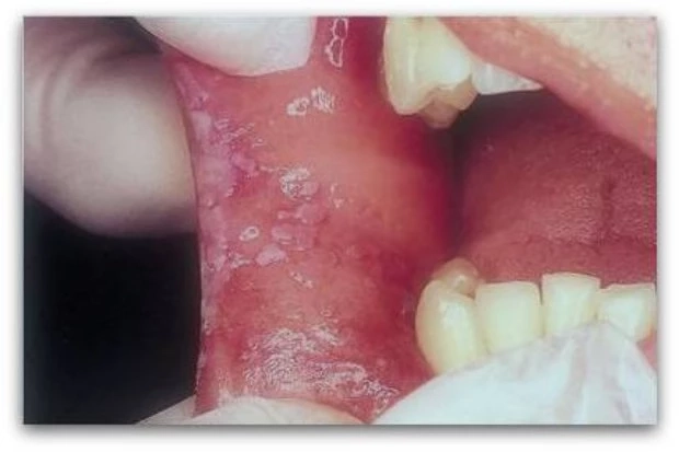 แพทย์เตือน มะเร็งช่องปาก เผยปัจจัยเสี่ยงที่จะเกิด มีอาการต้องรีบพบแพทย์