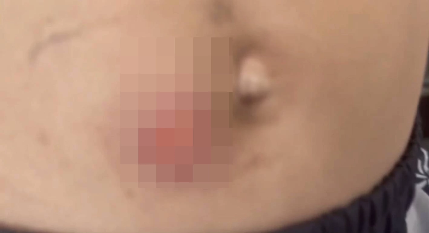 สภาพร่องรอยบาดแผลจากการถูกถ่านร้อนจี้สะดือ