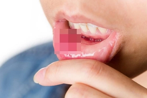 แพทย์เตือน มะเร็งช่องปาก เผยปัจจัยเสี่ยงที่จะเกิด มีอาการต้องรีบพบแพทย์