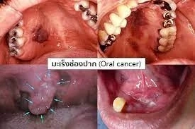 แพทย์เตือน มะเร็งช่องปาก เผยปัจจัยเสี่ยงที่จะเกิด มีอาการต้องรีบพบแพทย์