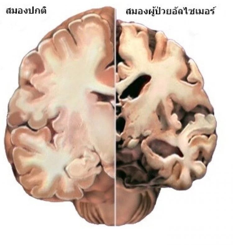 หมอดื้อเตือน "สมองเสื่อมวัยชราพุ่งสูง ตรวจรู้ล่วงหน้าช่วยได้ เอาชนะได้"