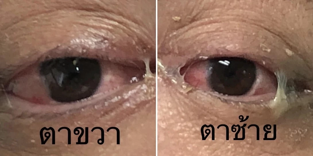 'หมอมนูญ' เผยข้อมูล ชายไทยวัย42 ติดโควิด-19 คาดสายพันธุ์ XBB.1.16