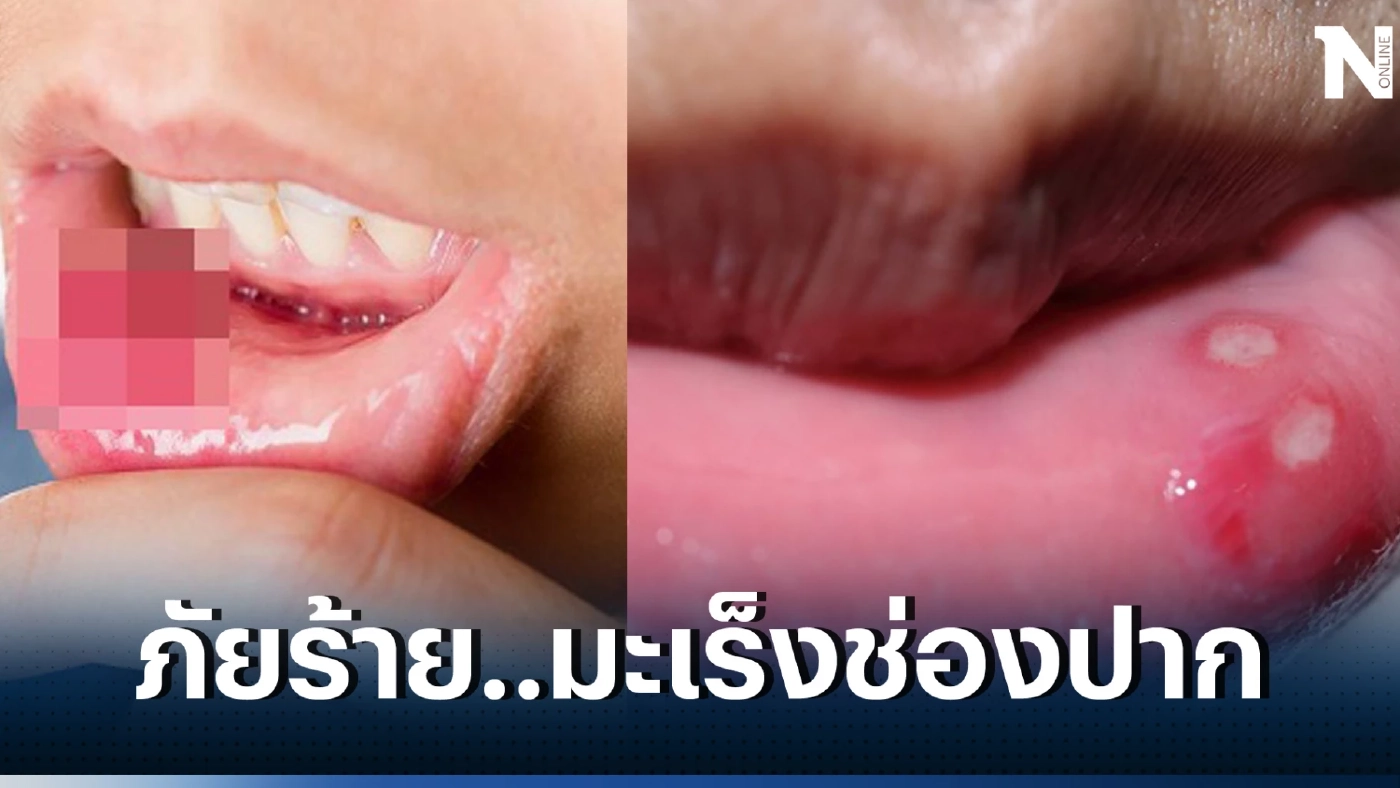 แพทย์เตือน มะเร็งช่องปาก เผยปัจจัยเสี่ยงที่จะเกิด มีอาการต้องรีบพบแพทย์
