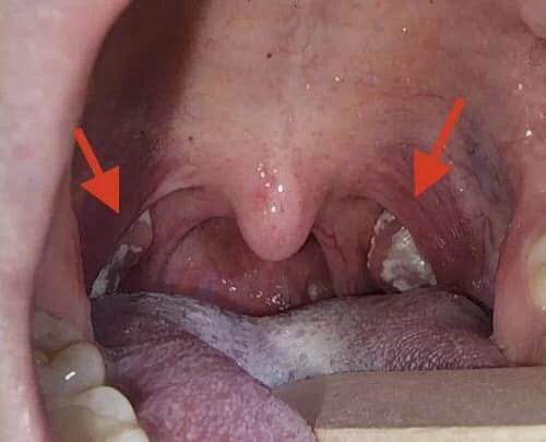 แพทย์ดัง เตือน "โรคโมโนนิวคลิโอซิส" ติดต่อผ่านการจูบ สัมผัสนํ้าลาย