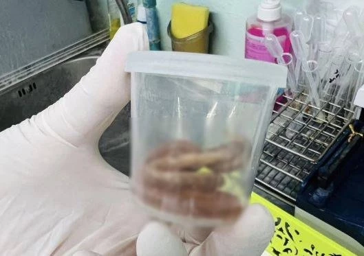 ช็อก! สาวท้องวัย 27 อาเจียน เจอพยาธิไส้เดือน ยาว 15 ซม.