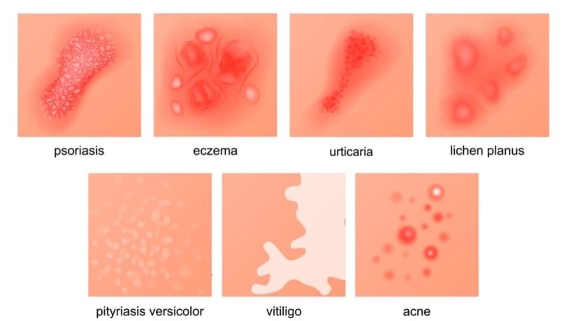 แพทย์ผู้เชี่ยวชาญเตือน! อากาศร้อนจัดทำร้ายผิวลึก พร้อมแนะวิธีดูแล
