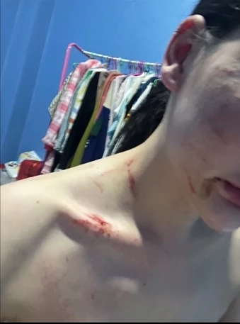 สภาพร่องรอยบาดแผล