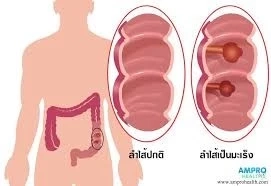 เช็กอาการ สัญญาณเตือน มะเร็งลำไส้ใหญ่ รีบพบแพทย์ด่วน ก่อนสายเกินไป