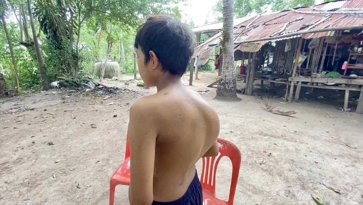 วอนช่วยด่วน เด็กวัย 15 หลังคดตาใกล้บอด ไร้เงินรักษา ถ้าไม่ผ่าอยู่ได้แค่ 3 ปี