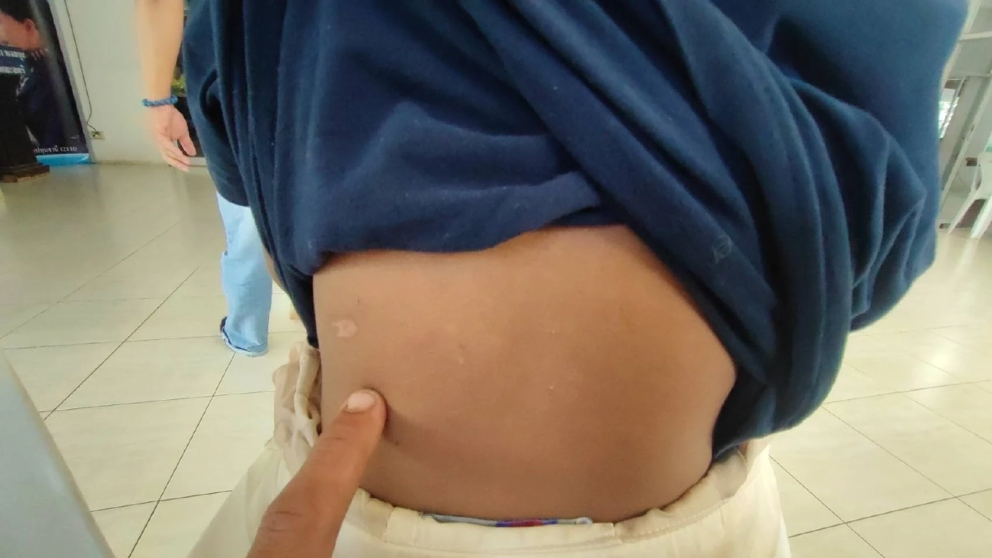 บาดแผลจากการถูกทำร้ายโดยพ่อเลี้ยง